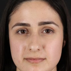 Liquid Rhinoplasty Before & After Patient #2188
