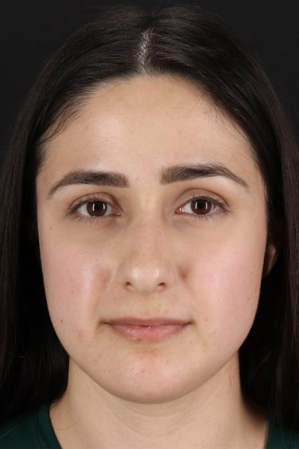 Liquid Rhinoplasty Before & After Patient #2188