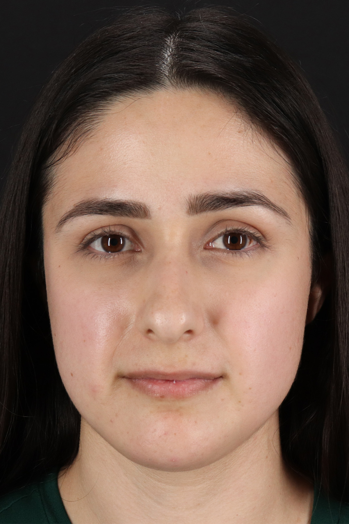Liquid Rhinoplasty Before & After Patient #2188