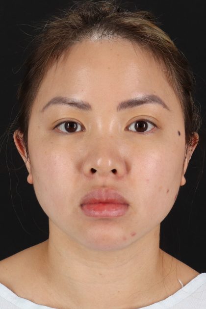 Chin Implant Before & After Patient #1507