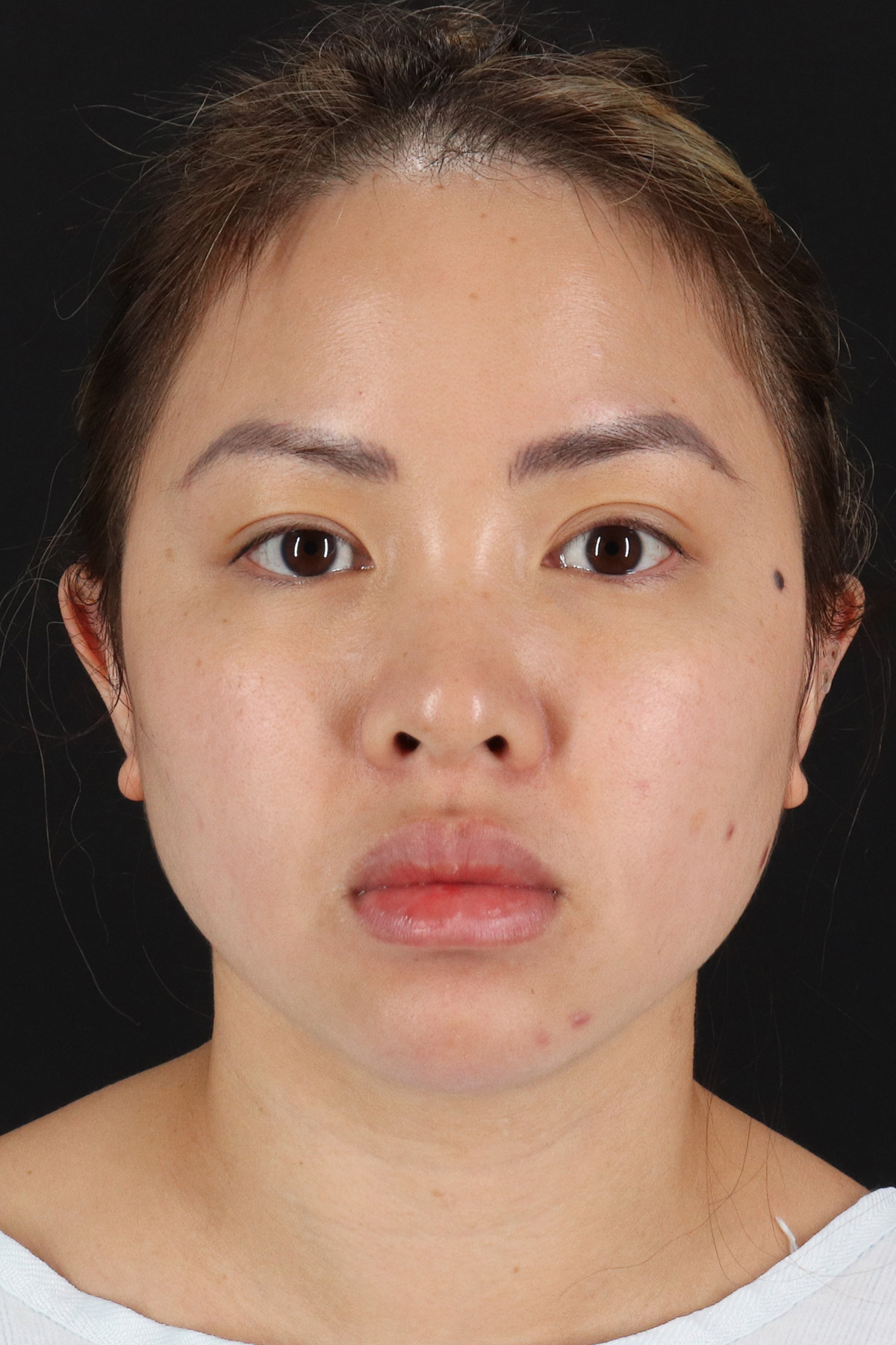 Chin Implant Before & After Patient #1507