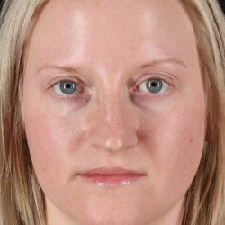Rhinoplasty Before & After Patient #3126