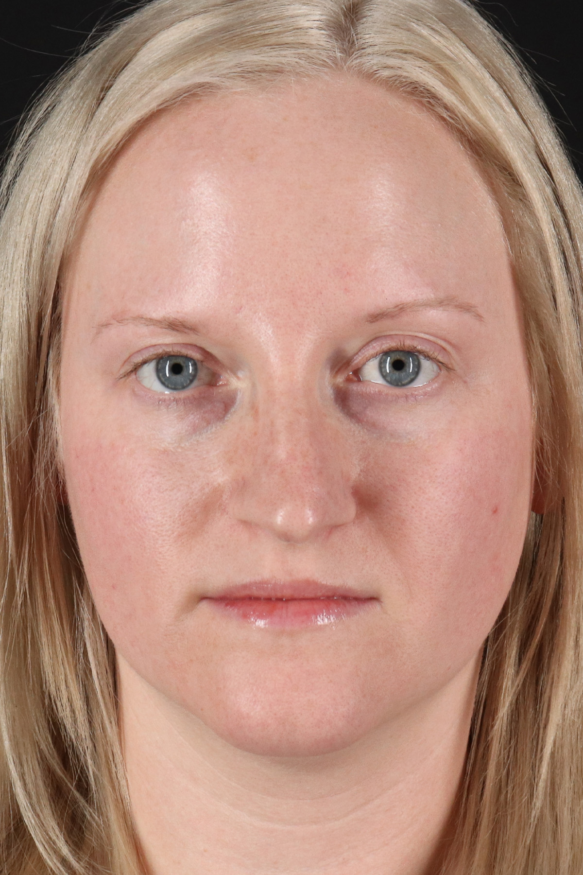 Rhinoplasty Before & After Patient #3126