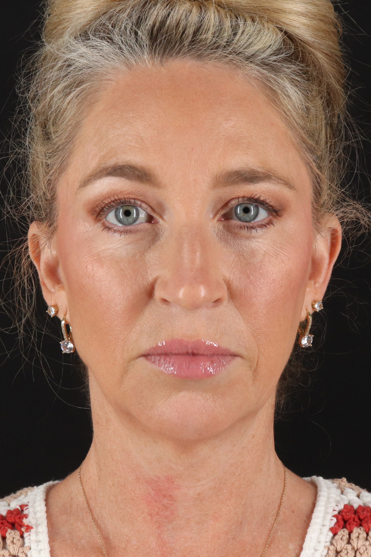 Neck Lift Before & After Patient #2441