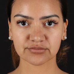 Rhinoplasty Before & After Patient #3192