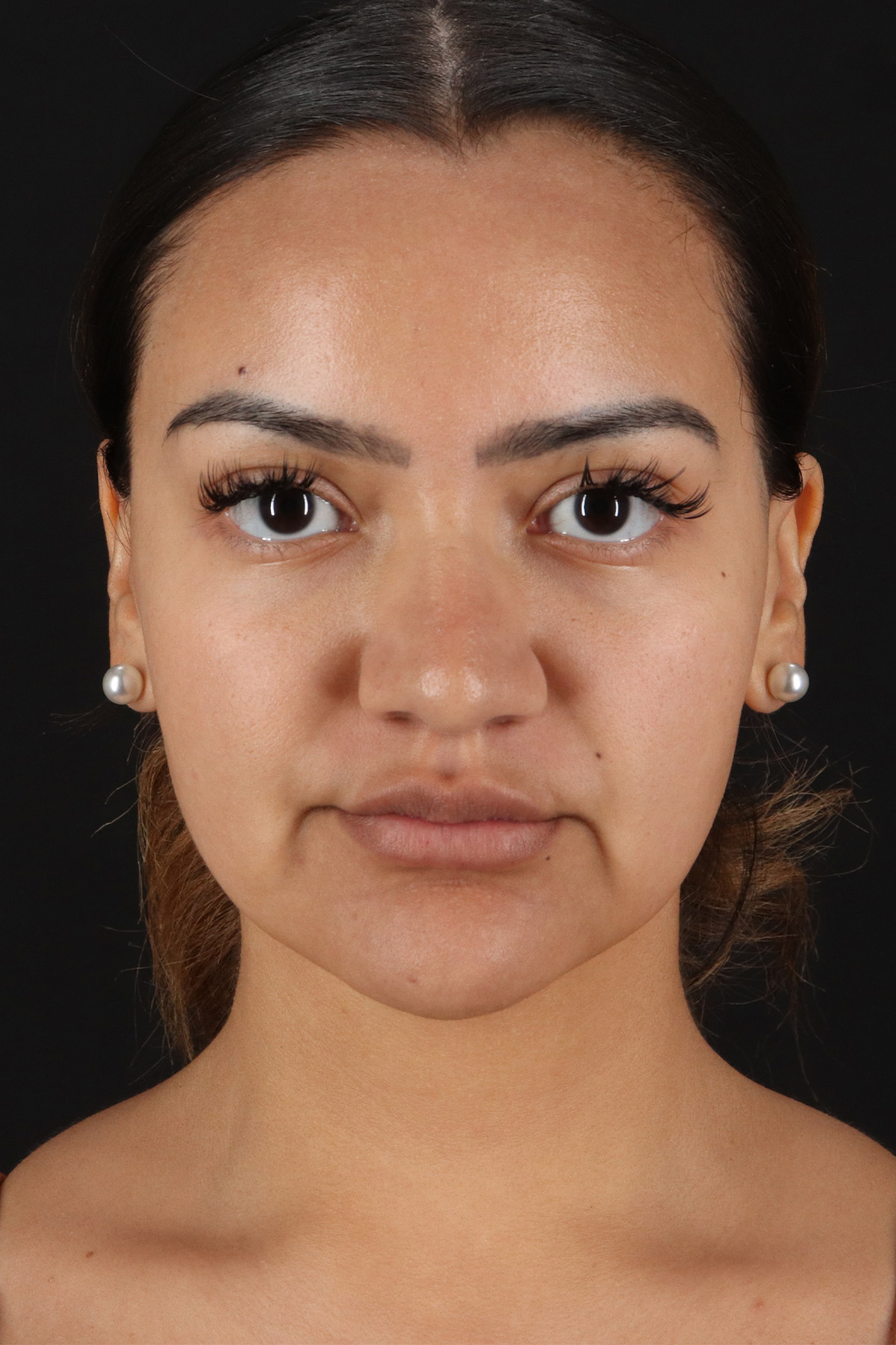 Rhinoplasty Before & After Patient #3192