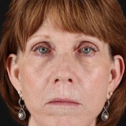 Lip Lift Before & After Patient #2155