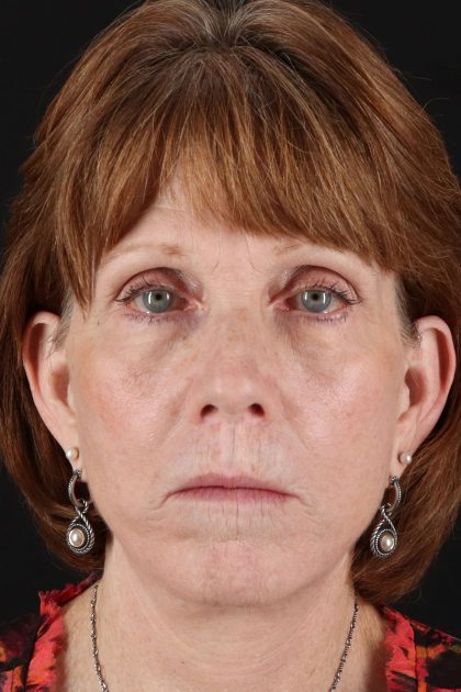 Lip Lift Before & After Patient #2155