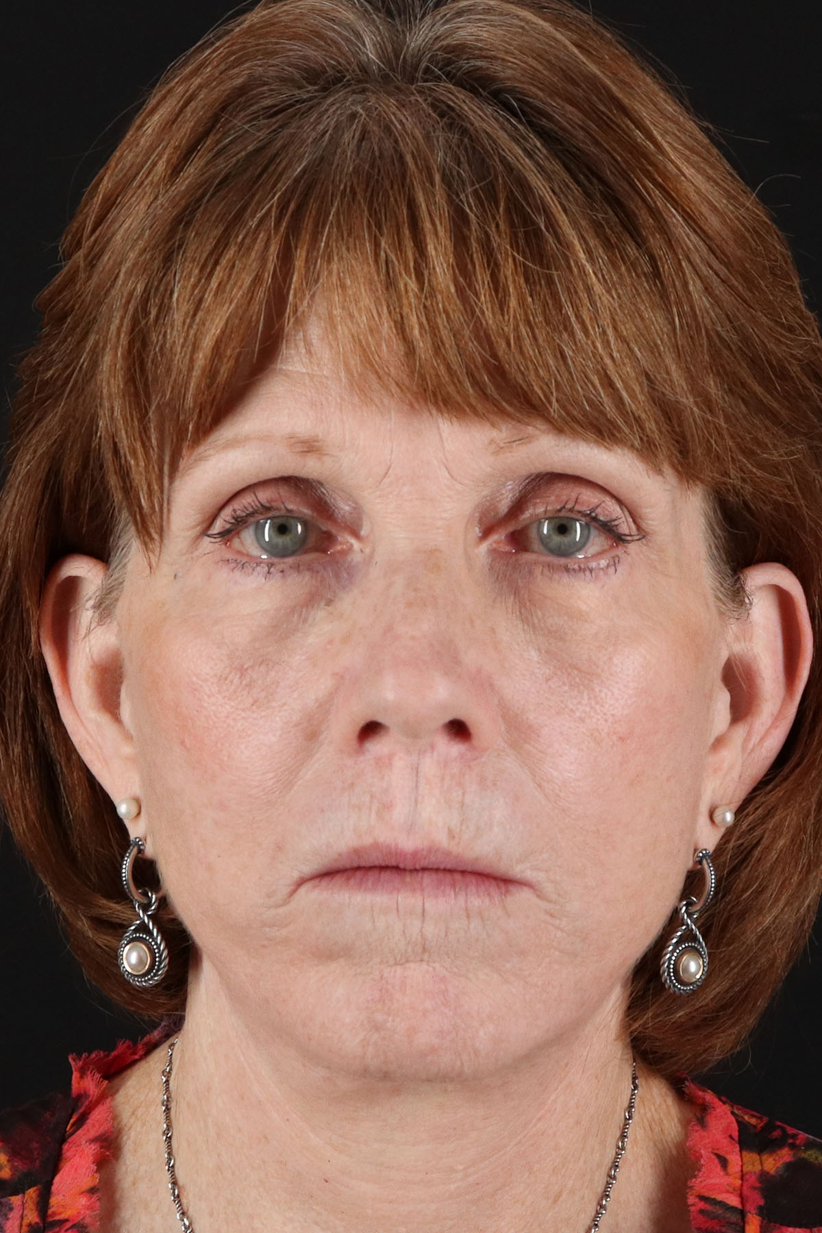 Lip Lift Before & After Patient #2155