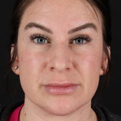 Rhinoplasty Before & After Patient #3093