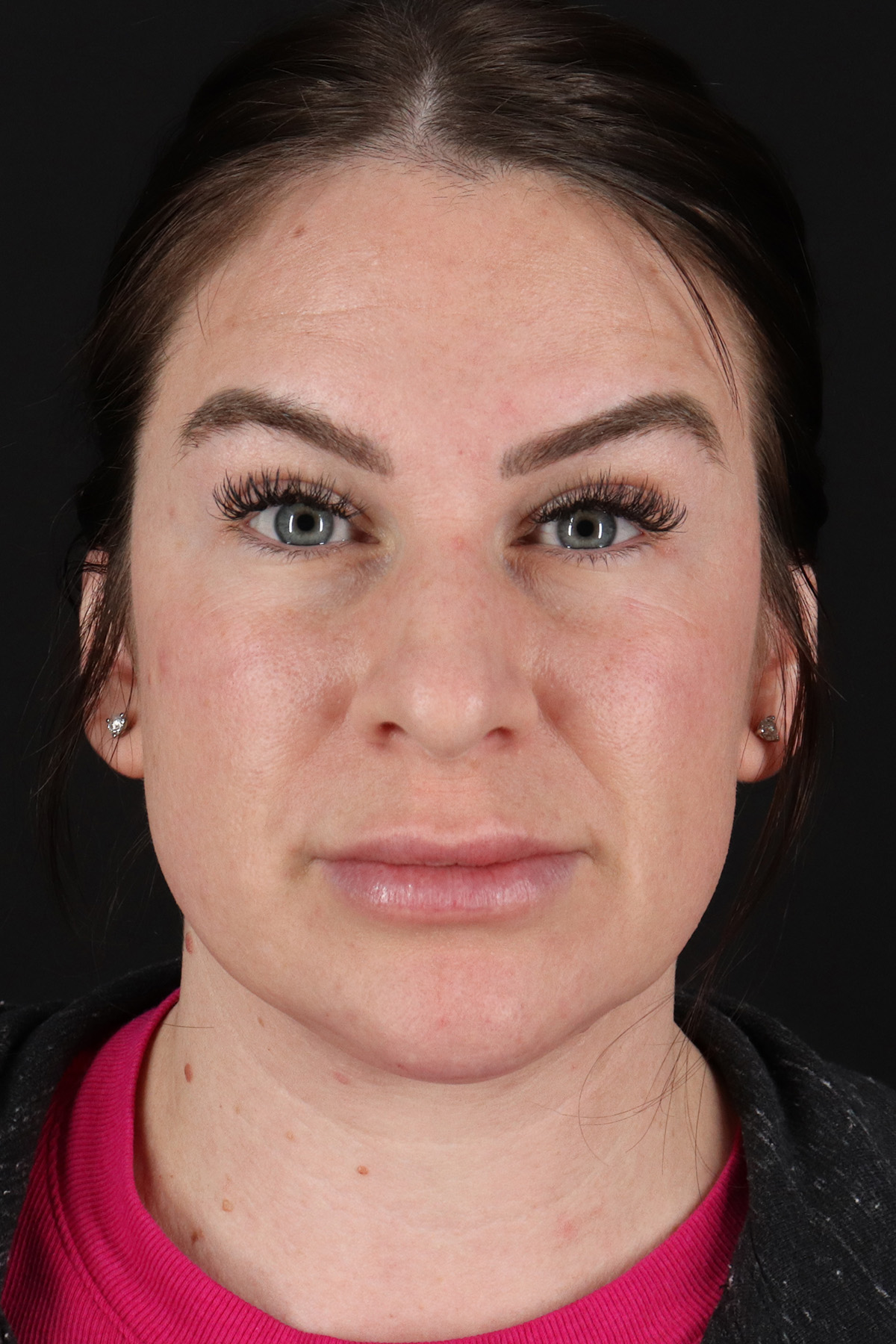 Rhinoplasty Before & After Patient #3093