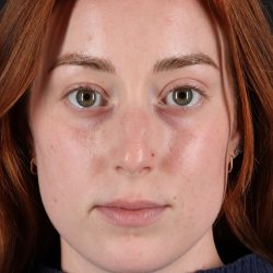 Rhinoplasty Before & After Patient #3170