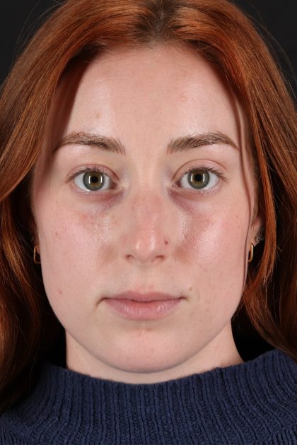Rhinoplasty Before & After Patient #3170