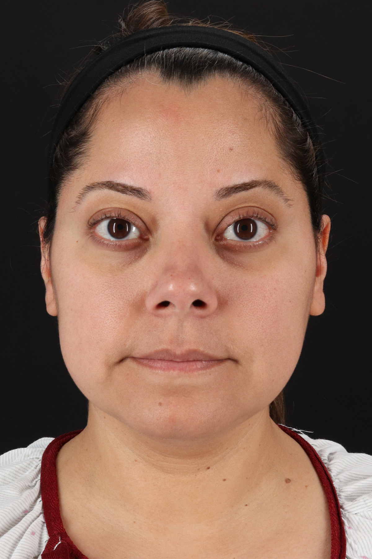 Buccal Fat Pad Before & After Patient #1436