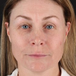 Lip Lift Before & After Patient #2144