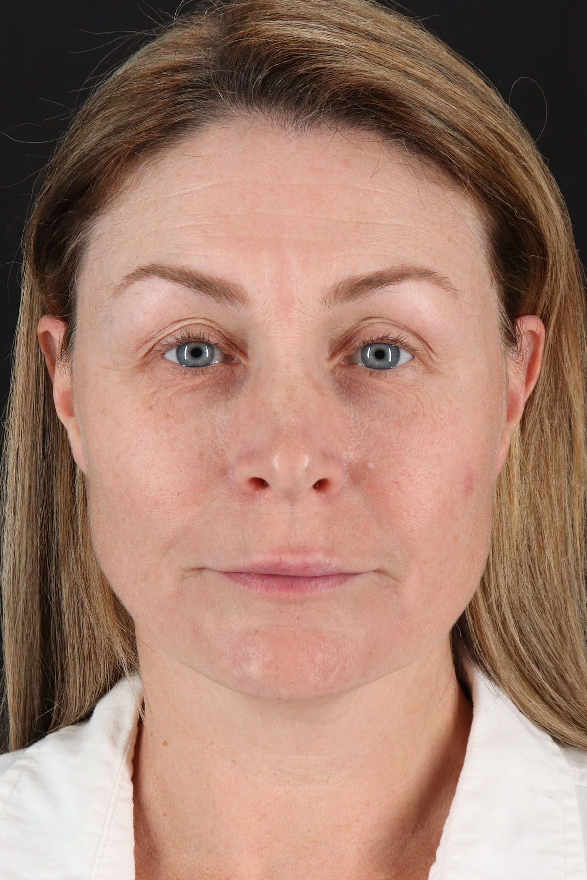 Lip Lift Before & After Patient #2144