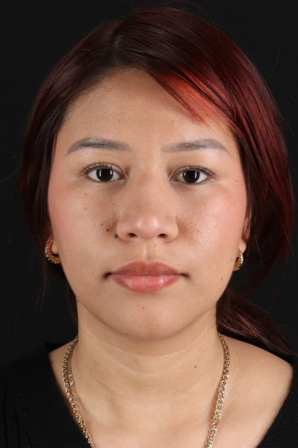 Rhinoplasty Before & After Patient #2829