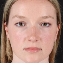 Liquid Rhinoplasty Before & After Patient #2177