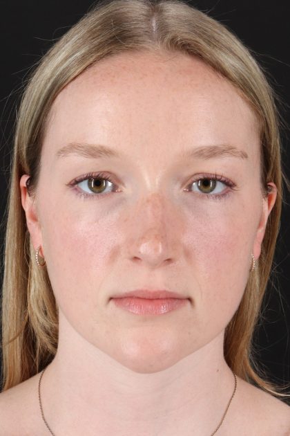Liquid Rhinoplasty Before & After Patient #2177