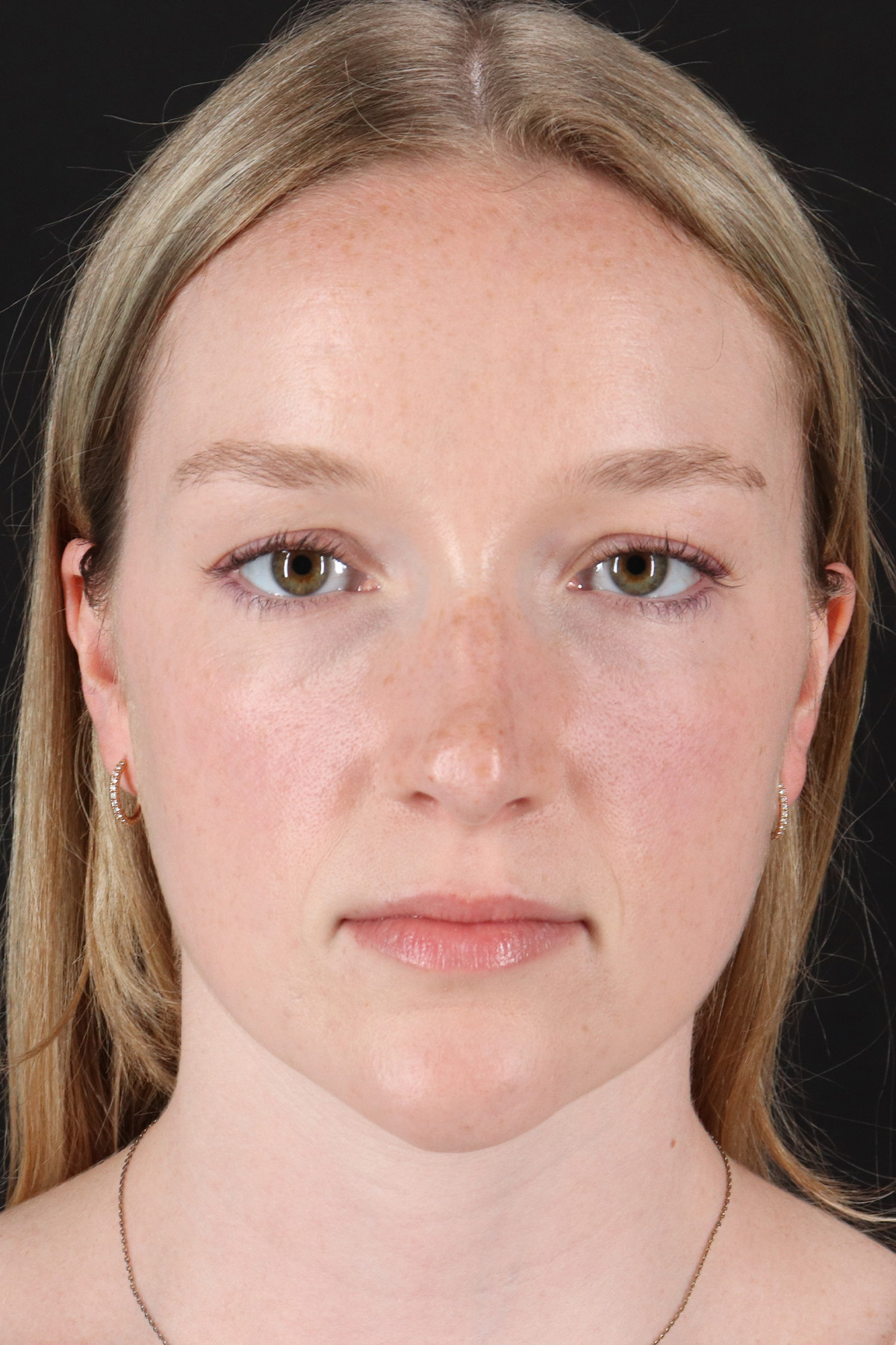 Liquid Rhinoplasty Before & After Patient #2177