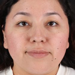 Rhinoplasty Before & After Patient #3060