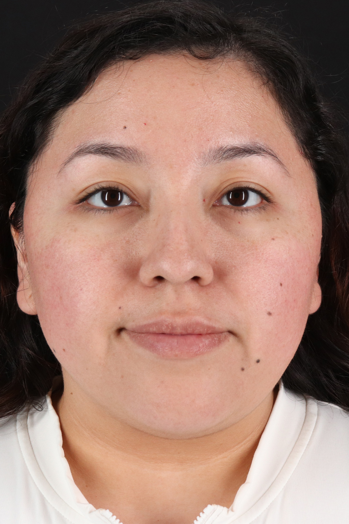 Rhinoplasty Before & After Patient #3060