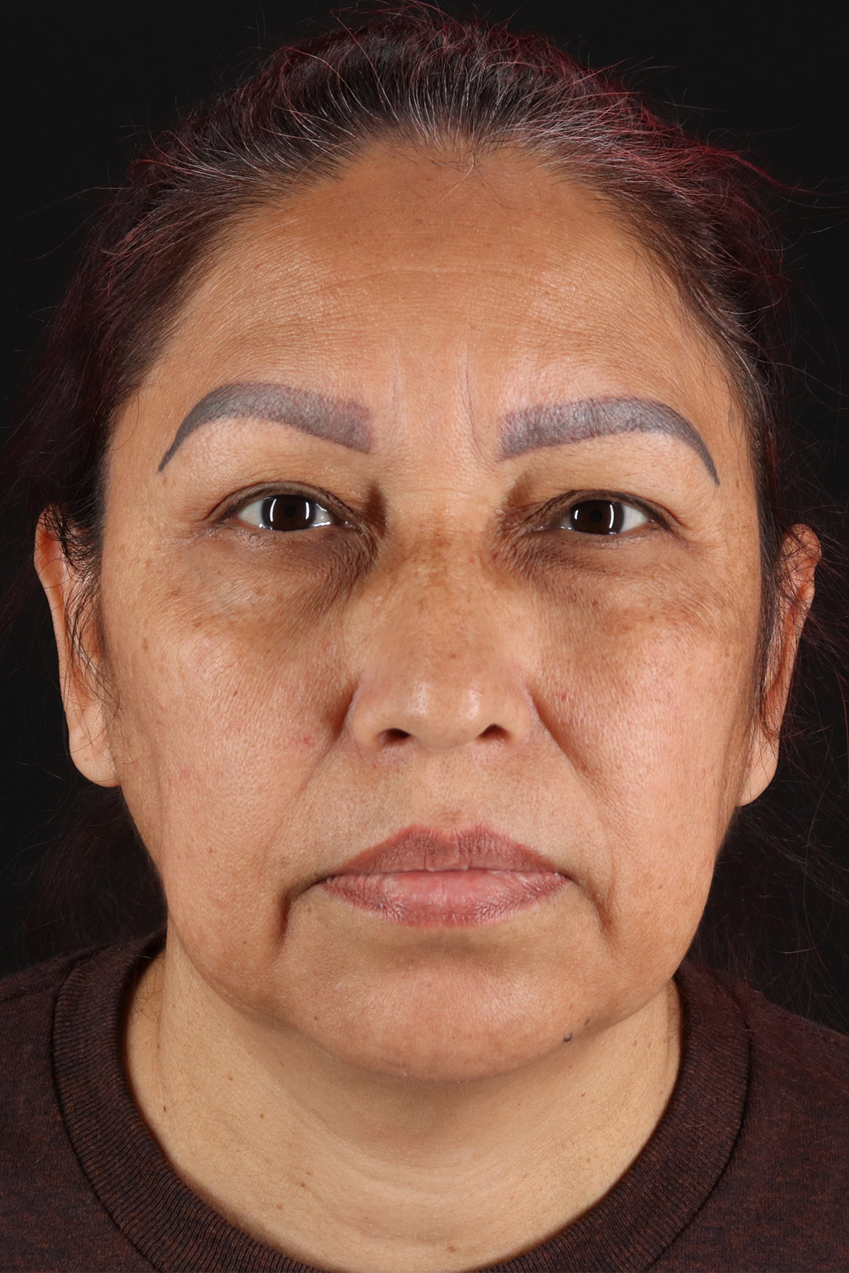 Lower Blepharoplasty Before & After Patient #2321
