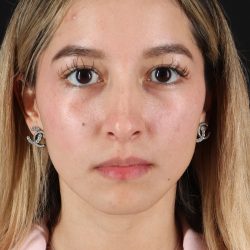 Rhinoplasty Before & After Patient #3302