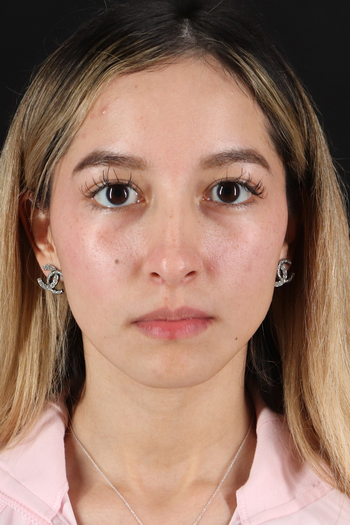 Rhinoplasty Before & After Patient #3302