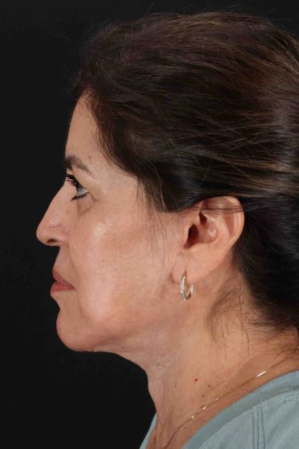 Facelift Before & After Patient #3544