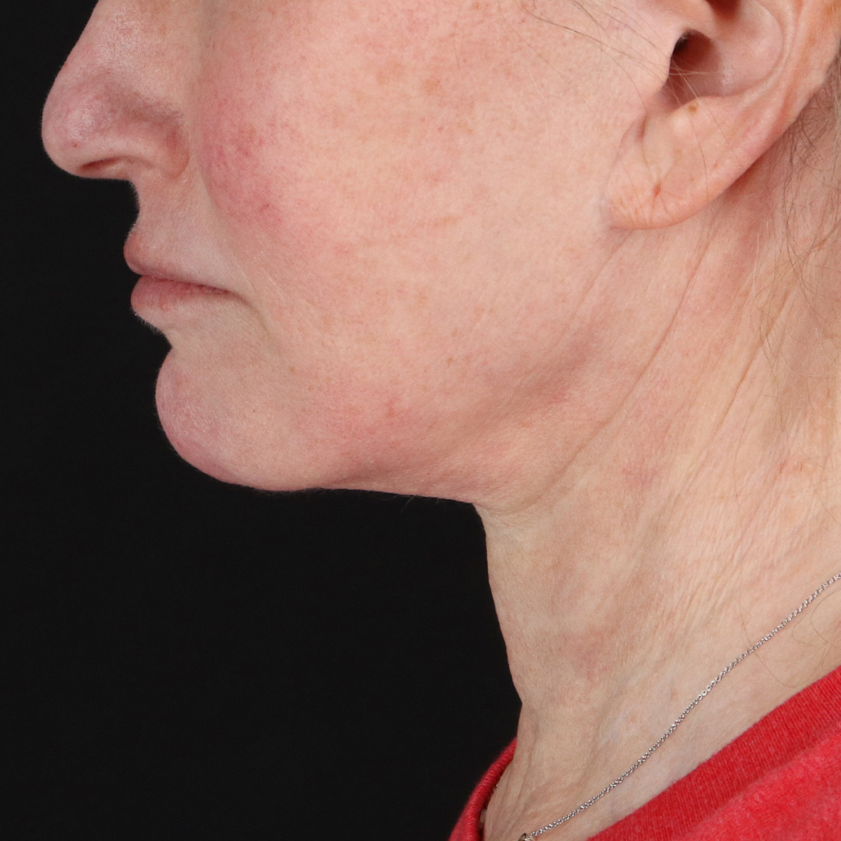 Neck Lift Before & After Patient #2571