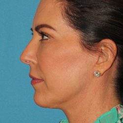 Chin Implant Before & After Patient #1659