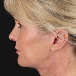 Neck Lift Before & After Patient #2582