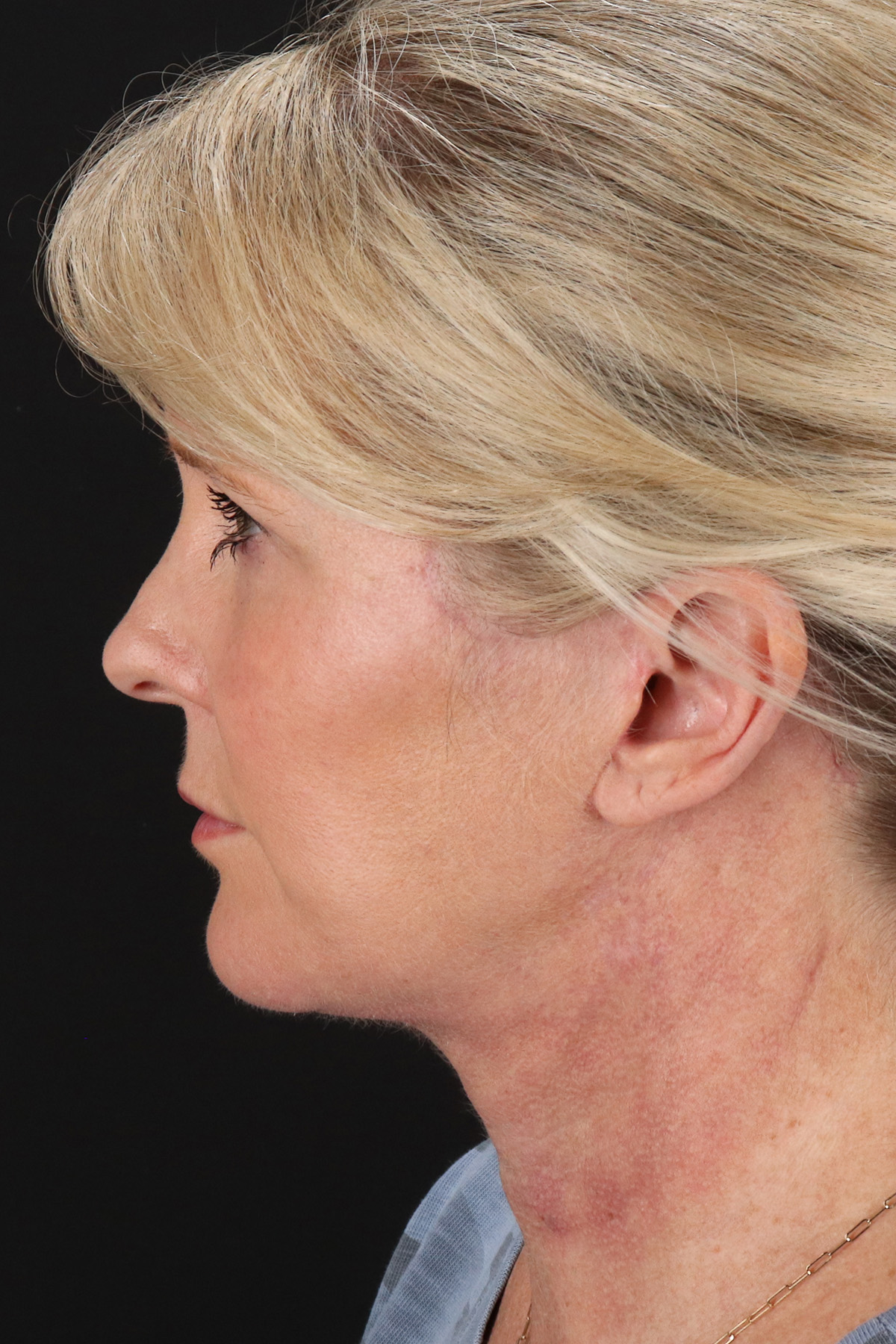 Facelift Before & After Patient #1877