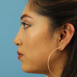 Chin Implant Before & After Patient #1670