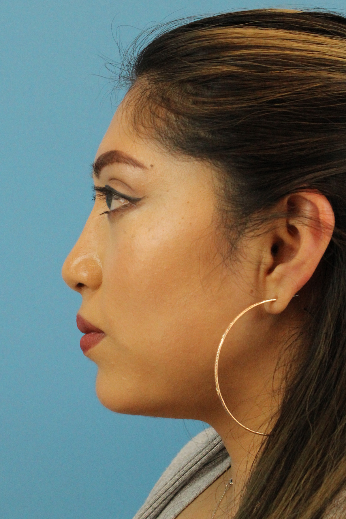 Chin Implant Before & After Patient #1670