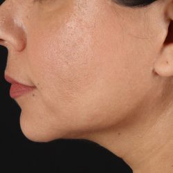 Facelift Before & After Patient #3555
