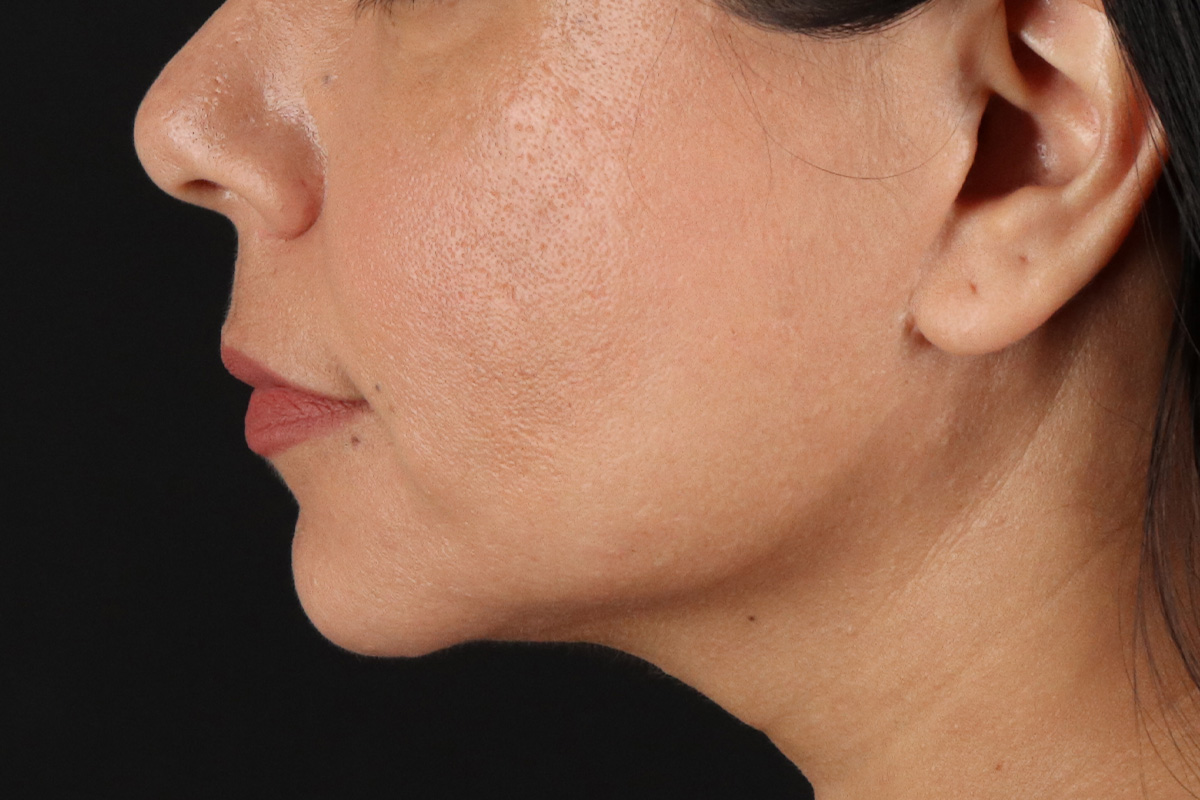 Facelift Before & After Patient #3555