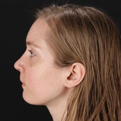 Rhinoplasty Before & After Patient #3280