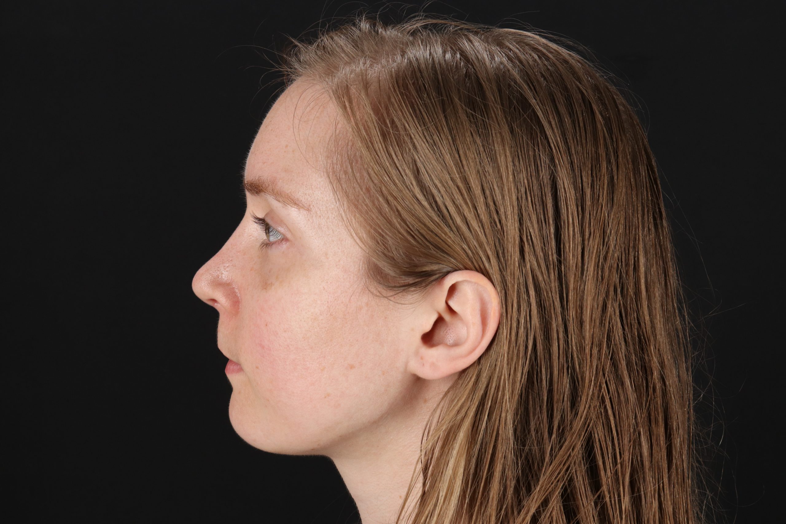 Rhinoplasty Before & After Patient #3280