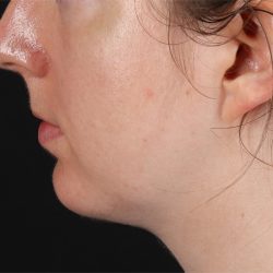 Chin Implant Before & After Patient #1562