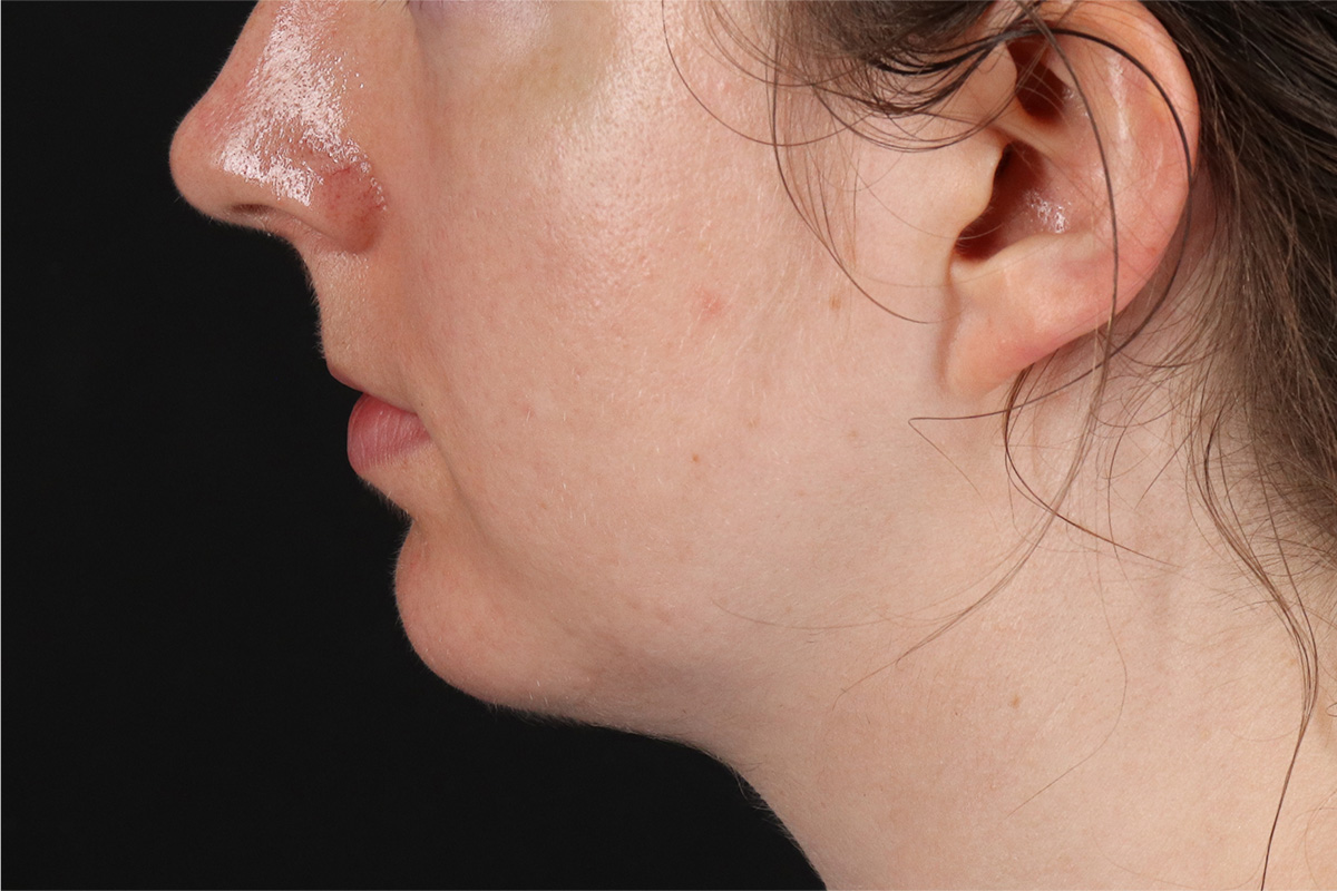 Chin Implant Before & After Patient #1562