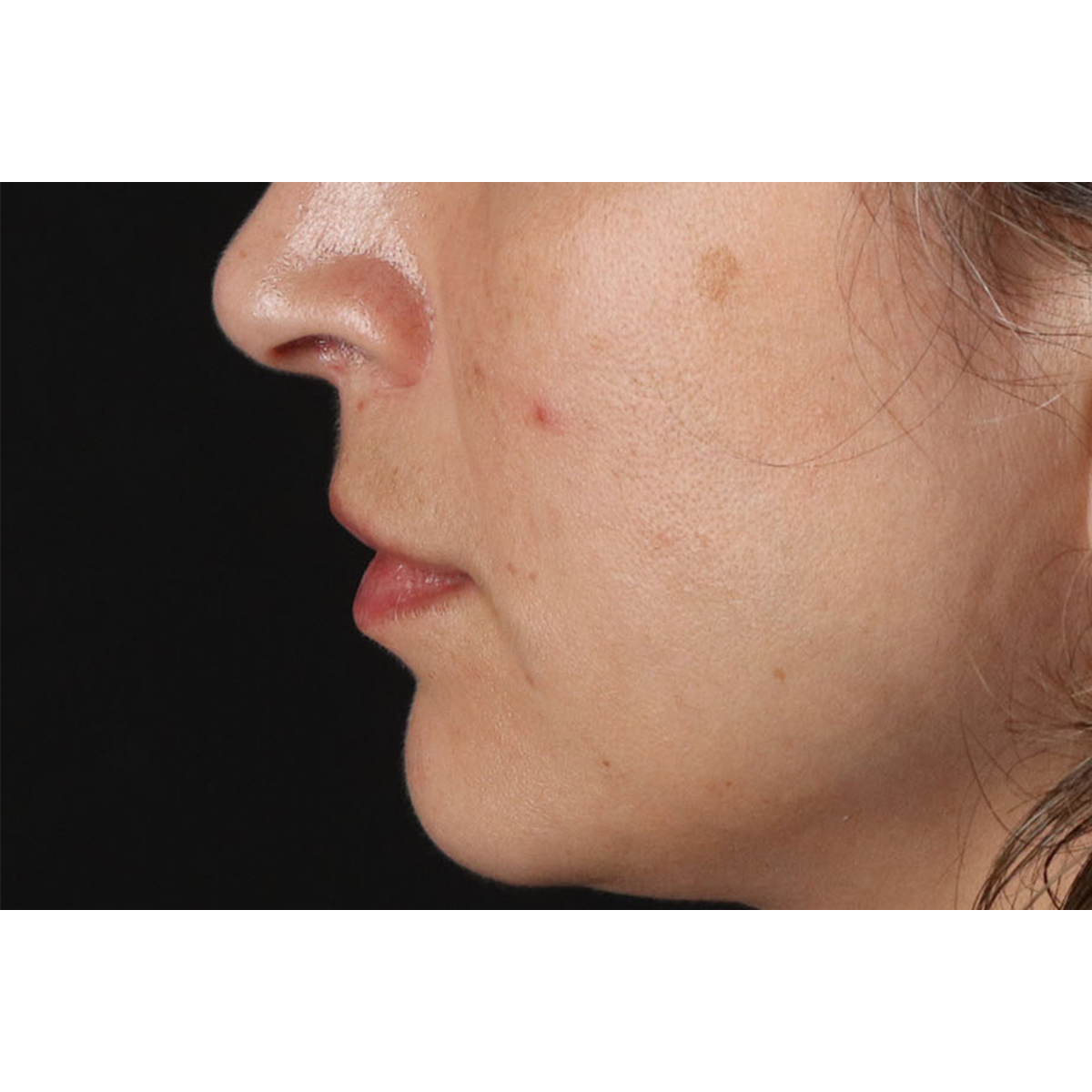Lip Lift Before & After Patient #2166