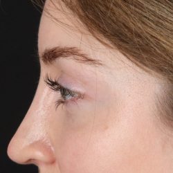 Browlift Before & After Patient #1319