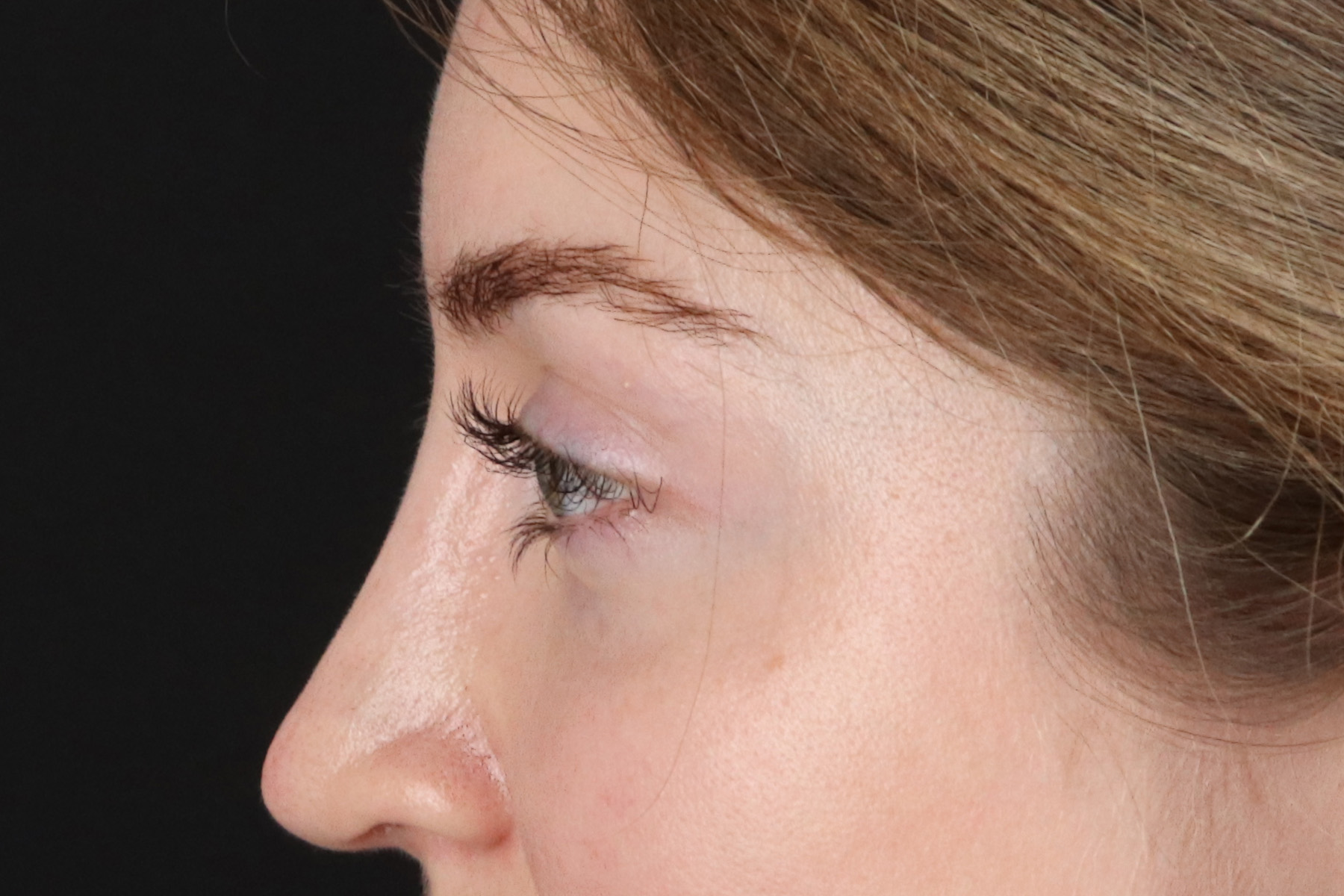 Browlift Before & After Patient #1319