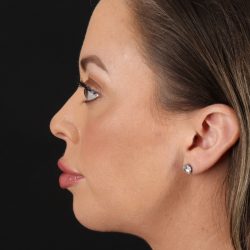Chin Implant Before & After Patient #1518