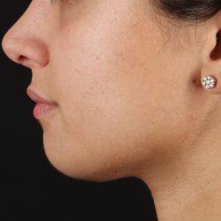 Chin Implant Before & After Patient #1573