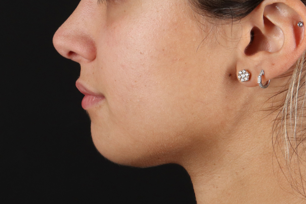 Chin Implant Before & After Patient #1573