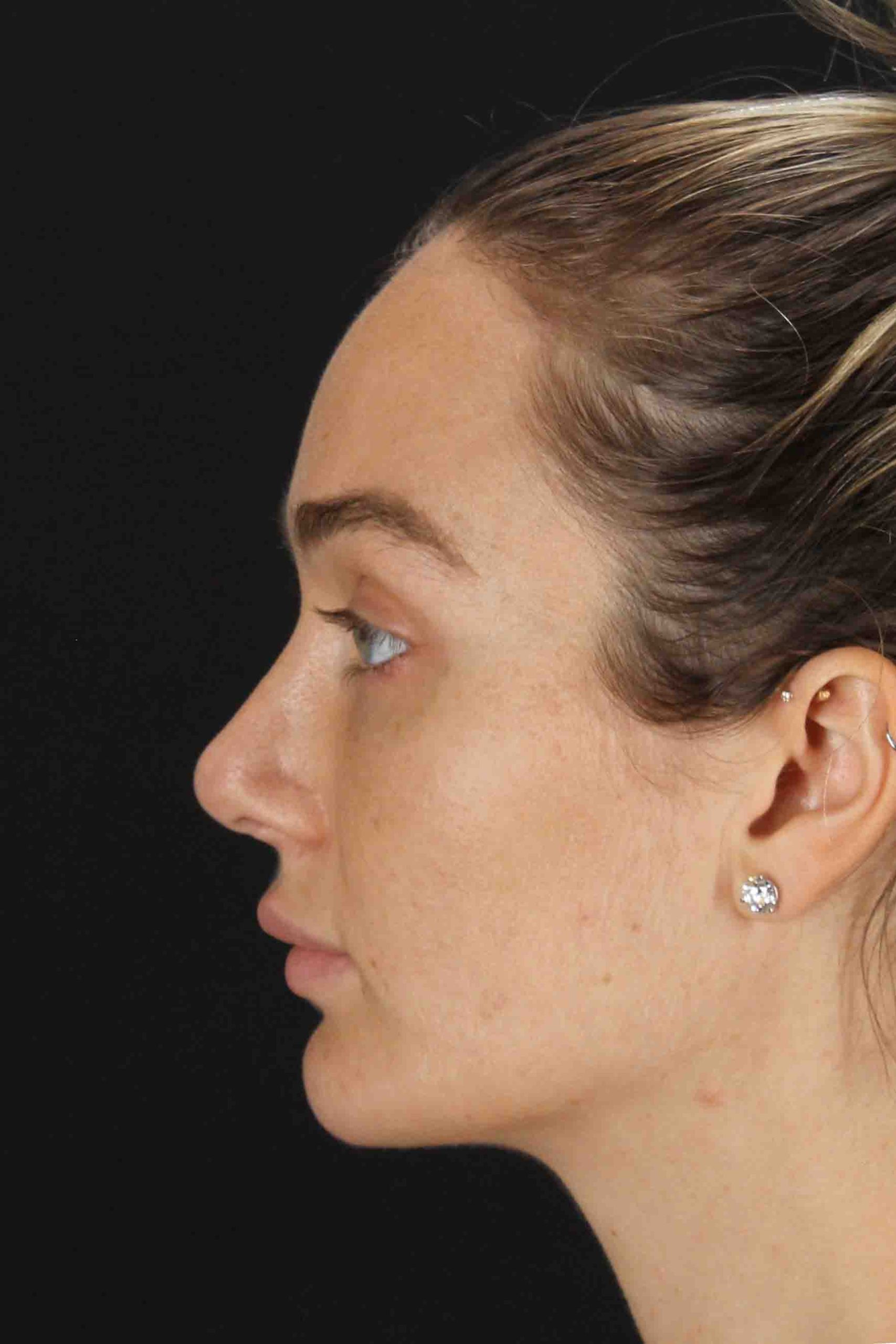 Browlift Before & After Patient #1297