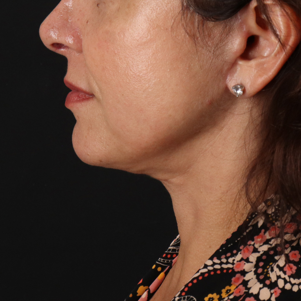 Neck Lift Before & After Patient #2472